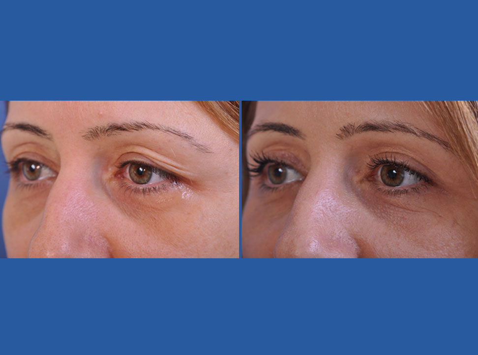 before and after blepharoplasty female patient left angle view case 2454