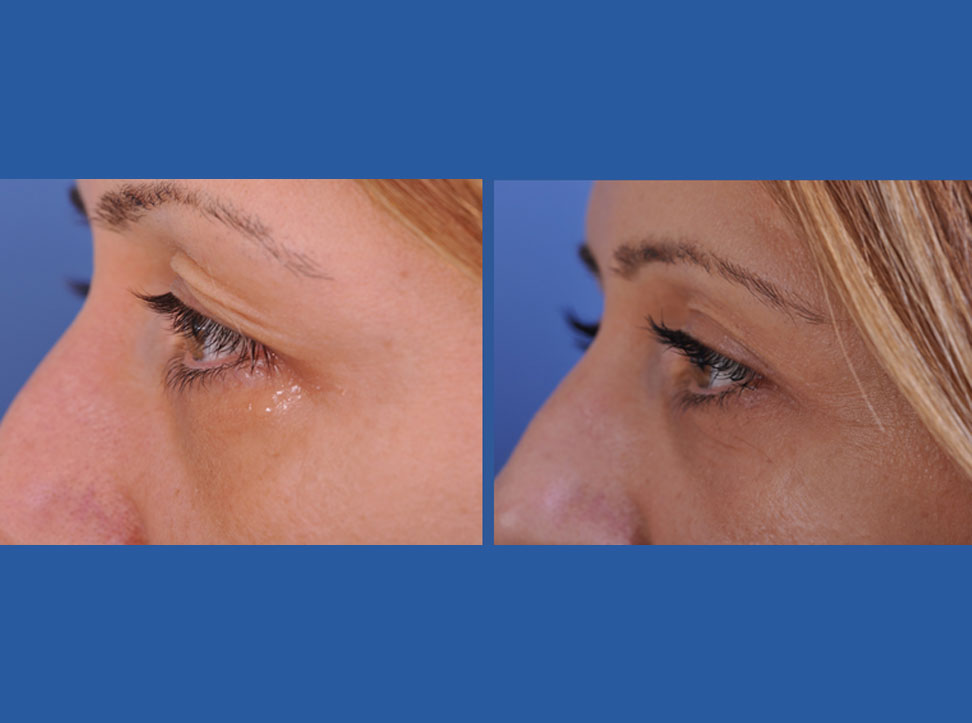 before and after blepharoplasty female patient left angle view case 2454