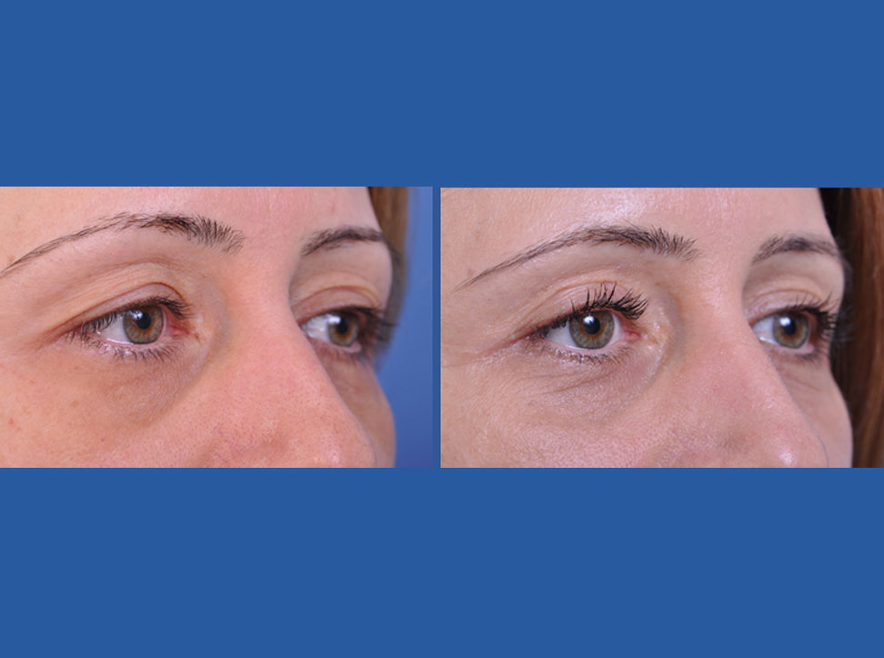before and after blepharoplasty female patient right angle view case 2454