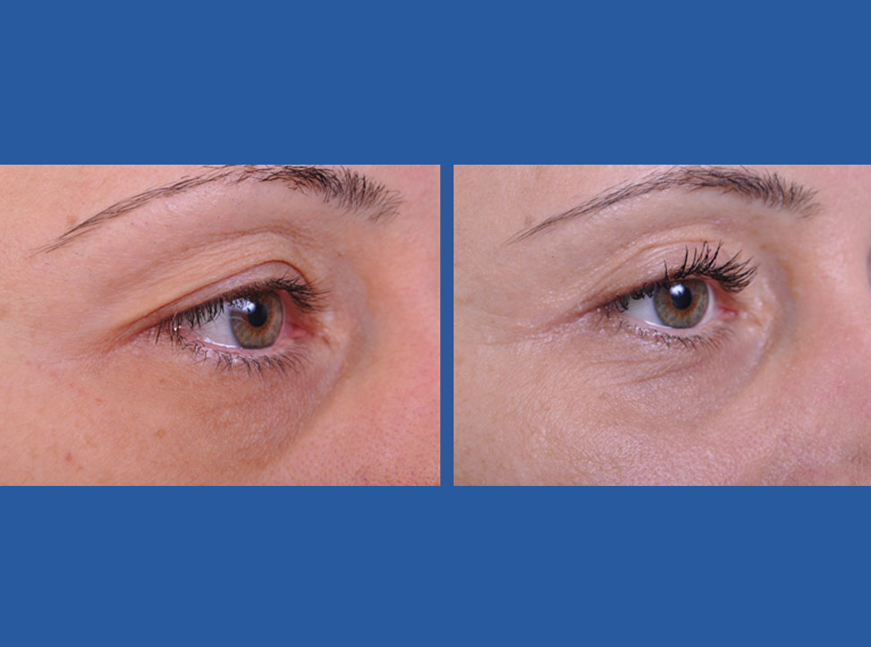 before and after blepharoplasty female patient right eye view case 2454