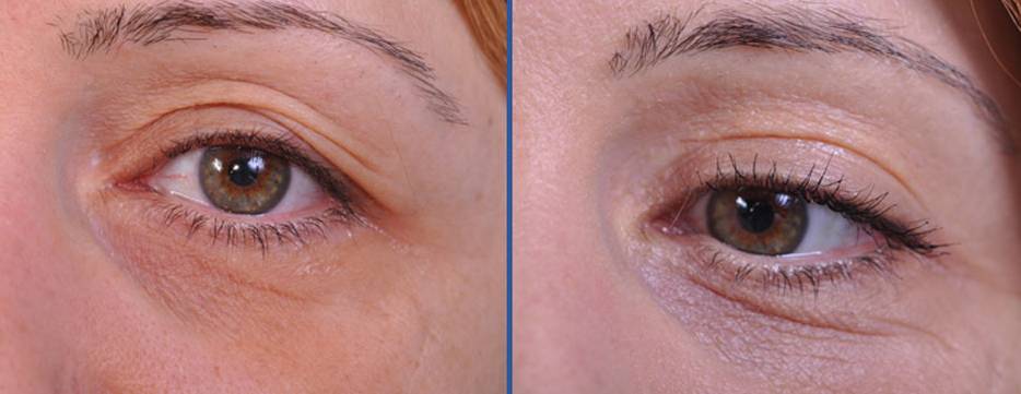 before and after blepharoplasty female patient closeup of right eye view case 2454