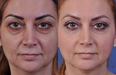 before and after blepharoplasty female patient front view case 2475