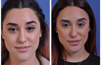 before and after chin reduction female patient front view case 2166