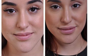 before and after chin reduction female patient front view case 2166