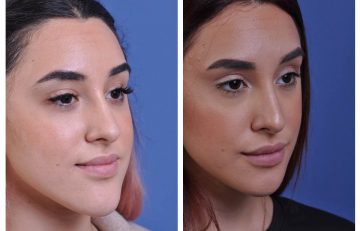 before and after chin reduction female patient right angle view case 2166