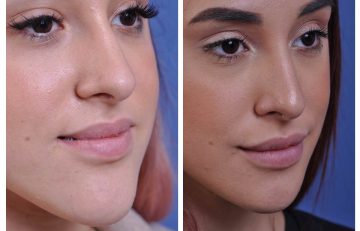 before and after chin reduction female patient right angle view case 2166