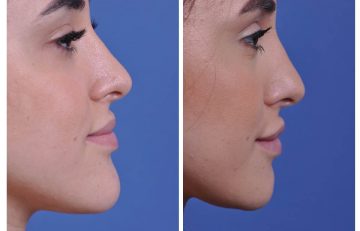 before and after chin reduction female patient right side view case 2166