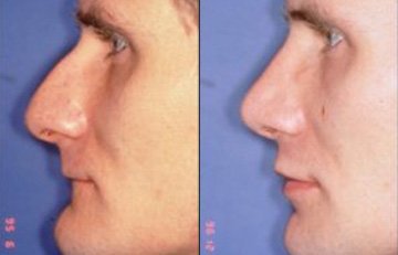 before and after chin reduction male patient left side view case 2183