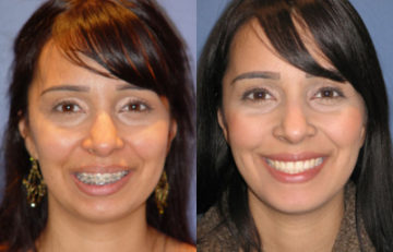 before and after chin augmentation female patient front view case 2607