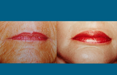 before and after chin augmentation | chin reduction front view close up case 3383