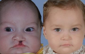 before and after cleft lip and palate front view case 2652