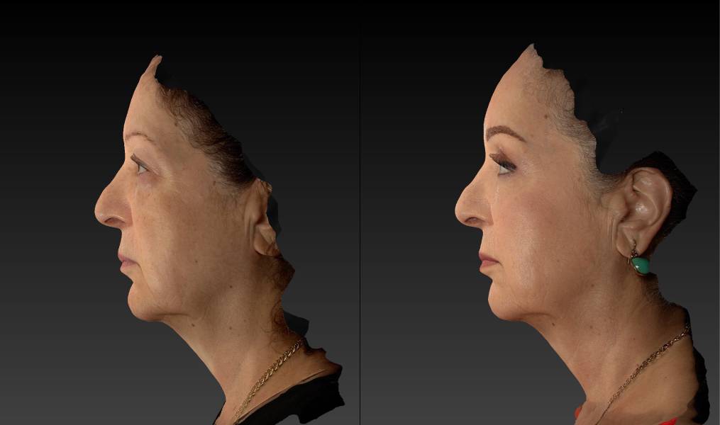 before and after brow lift | forehead lift female patient left side view case 3119