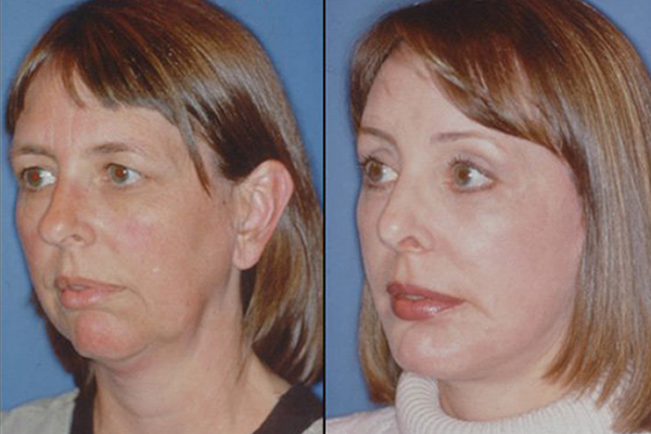 before and after Endoscopic Brow Lift | Forehead Lift left angle view female patient case 2389