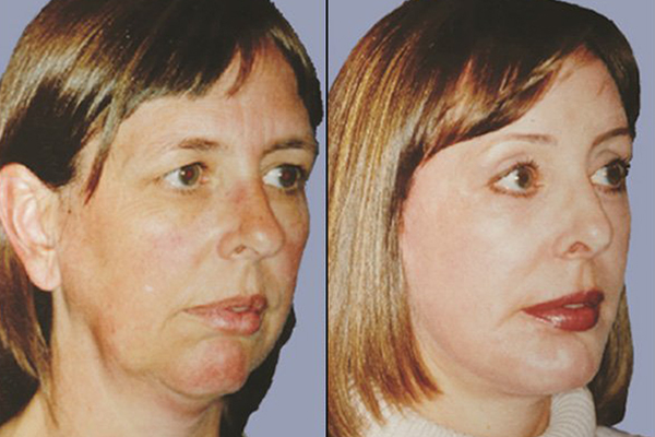 before and after Endoscopic Brow Lift | Forehead Lift right angle view female patient case 2389