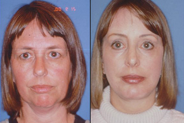 before and after Endoscopic Brow Lift | Forehead Lift front view female patient case 2389