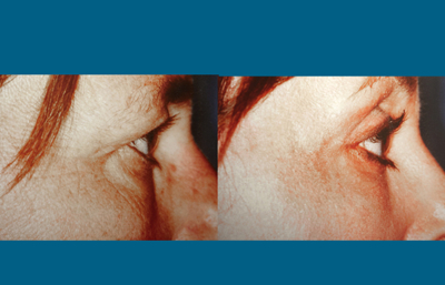 before and after eyelid surgery left side eye view female patient case 2479