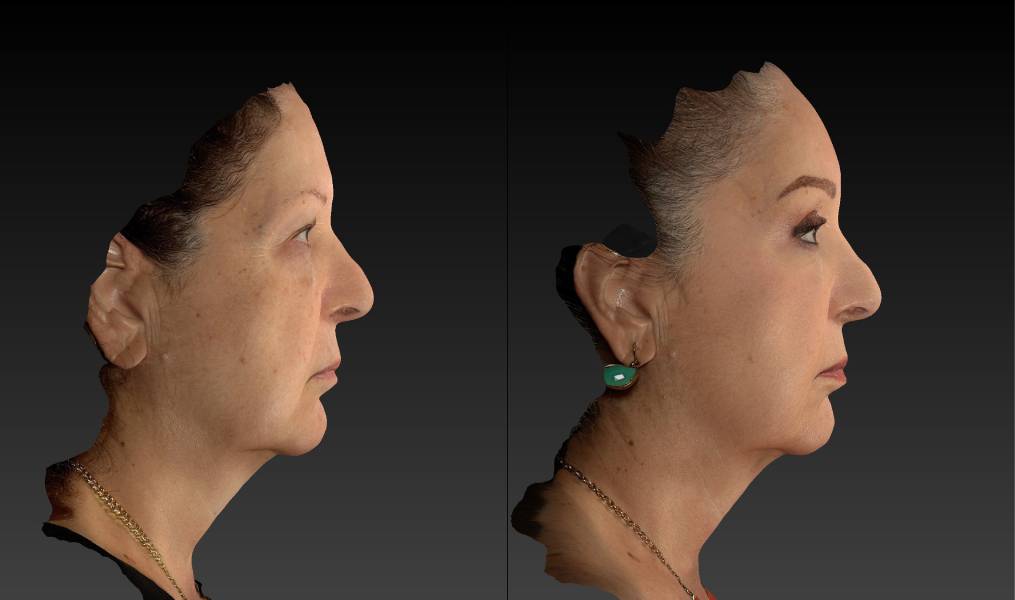 before and after eyelid surgery female patient right side view case 3112