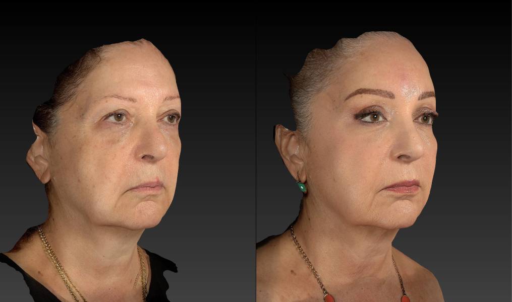 before and after eyelid surgery female patient right angle view case 3112