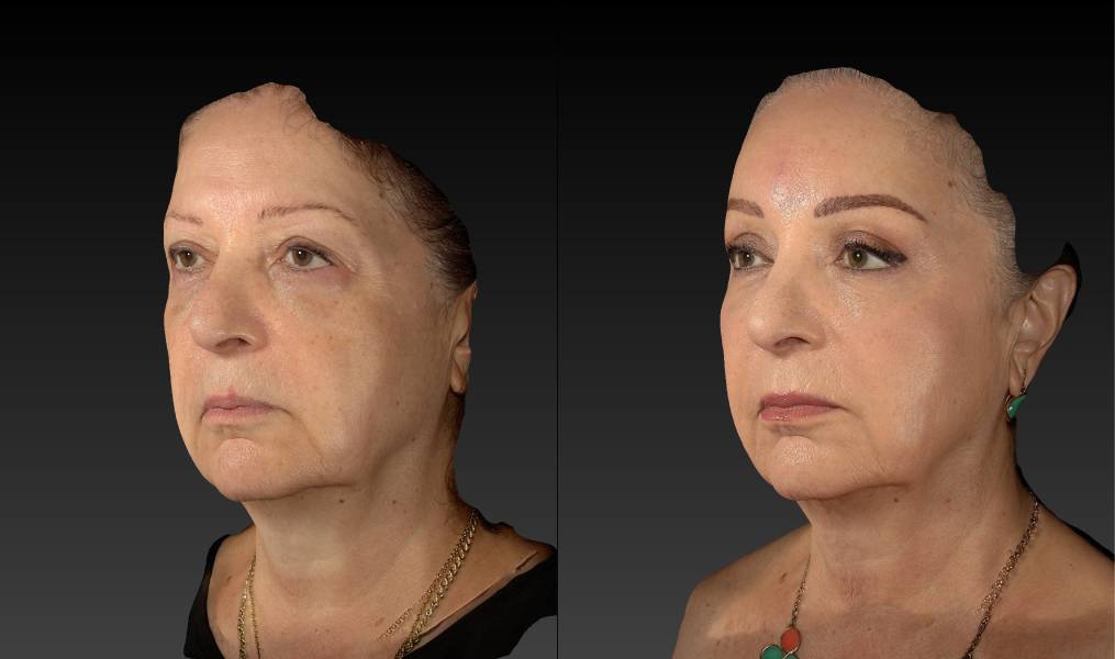 before and after eyelid surgery female patient left angle view case 3112