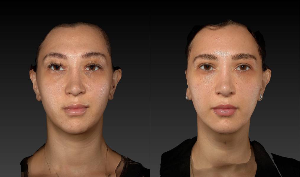 before and after eyelid surgery female patient front view case 3125