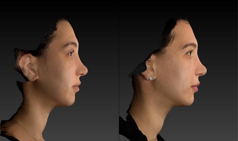 before and after eyelid surgery female patient right side view case 3125