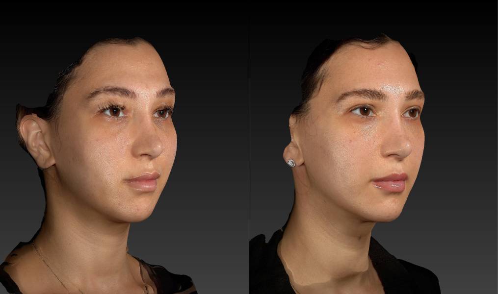 before and after eyelid surgery female patient right angle view case 3125