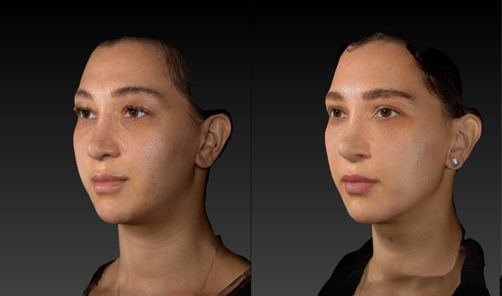 before and after eyelid surgery female patient left angle view case 3125