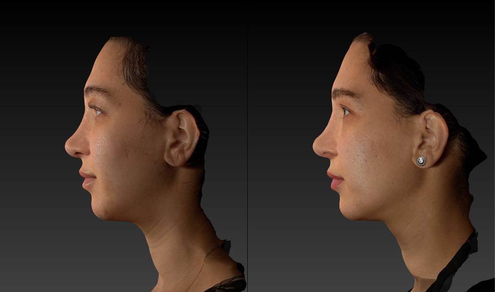 before and after eyelid surgery female patient left side view case 3125