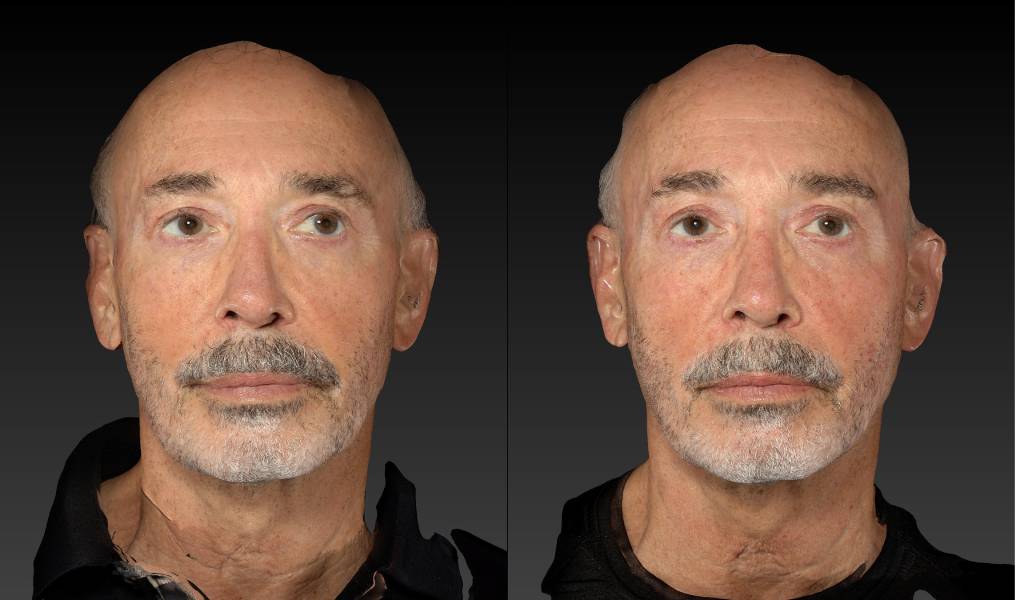 before and after eyelid surgery male patient front view case 3132