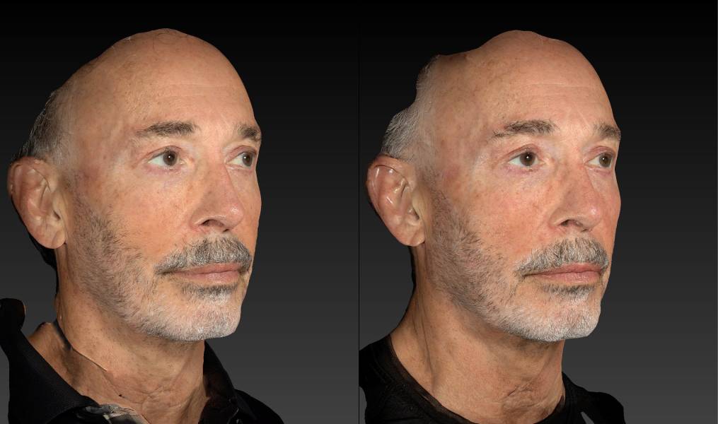 before and after eyelid surgery male patient right angle view case 3132