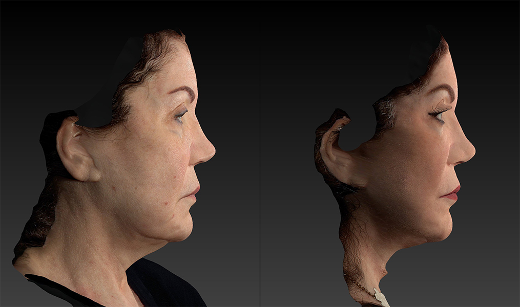 before and after facelift | mid-facelift right side view case 2906