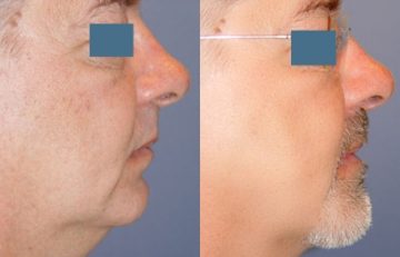 before and after facial implants right side view case 2592
