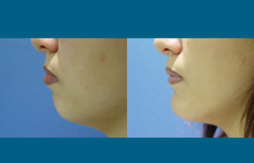 before and after facial implants left side view case 2597