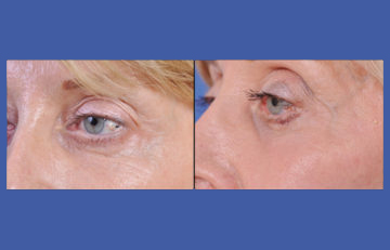 before and after laser skin resurfacing left angle view female patient case 2328