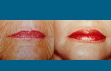 before and after laser skin resurfacing lower face view female patient case 2332