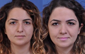 before and after laser skin resurfacing front view female patient case 2350