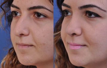 before and after laser skin resurfacing left angle view female patient case 2350