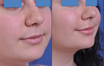 before and after neck lift female patient right angle view case 2443