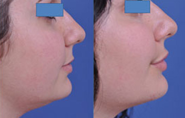 before and after neck lift female patient right side view case 2443