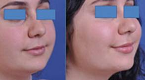 before and after neck lift female patient right angle view case 2443