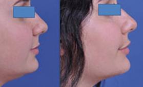 before and after neck lift female patient right side view case 2443