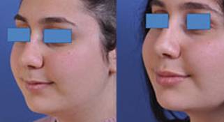 before and after neck lift female patient left angle view case 2443