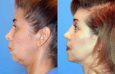 before and after neck lift left side view case 3365