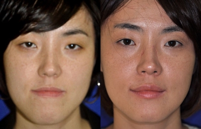before and after orthognathic surgery front view case 2539