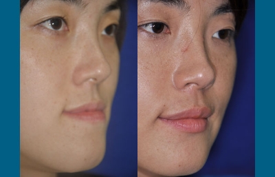 before and after orthognathic surgery right angle view case 2539