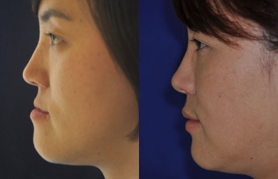 before and after orthognathic surgery left side view case 2539