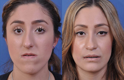 before and after orthognathic surgery female patient front view case 2544