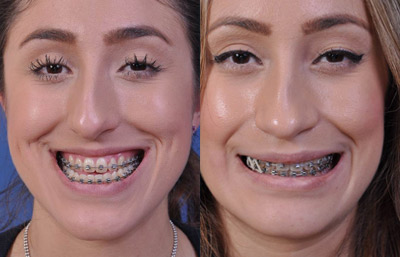 before and after orthognathic surgery female patient front view case 2544