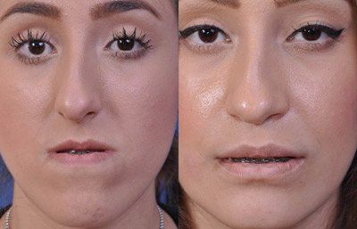 before and after orthognathic surgery female patient front view case 2544