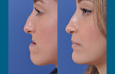 before and after orthognathic surgery female patient left side view case 2544